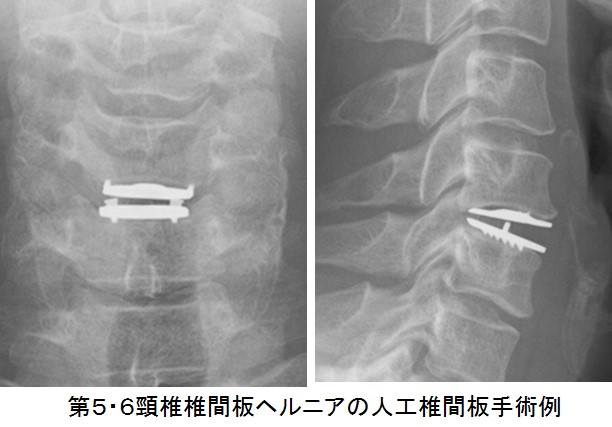 ヘルニア 手術 椎間板